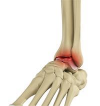 Ankle Arthritis