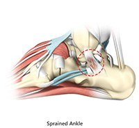 Ankle Sprains