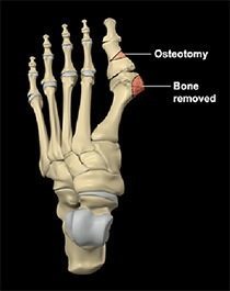 Foot Reconstruction