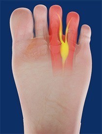 Morton’s Neuroma