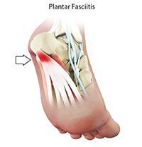 Plantar Fasciitis