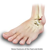 Stress Fractures